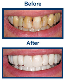 Dental Veneers East Windsor NJ