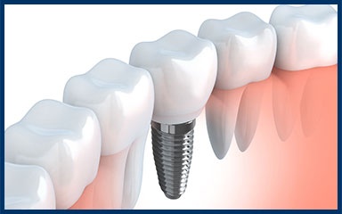 Implant Dentistry East Windsor NJ