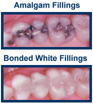 White Dental Fillings East Windsor NJ